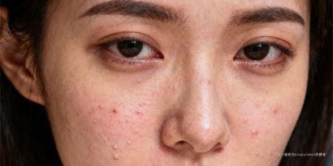 敏感肌的形成与遗传、环境及生活习惯有关，其中「饮食」是不可忽视的重要因素。某些食物可能透过引发发炎反应、释放组织胺或削弱皮肤屏障而加剧敏感症状，导致红、痒、刺痛甚至痘痘生成。了解哪些食物容易诱发敏感，能帮助敏感肌人群更好地进行日常饮食管理，降低肌肤不适。